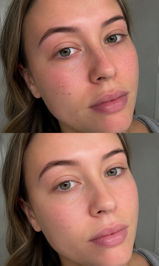 Skin transformation before and after